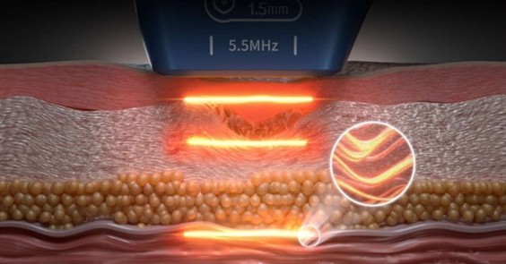 HIFU machine thermal and mechanical effect on skin tissue