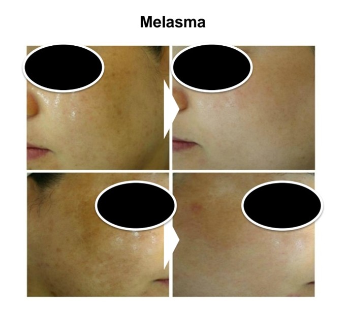Q-Switch laser machine before and after pigmentation treatment result