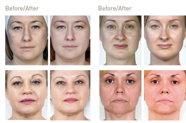 Mesogun machine Malaysia mesotherapy injection device for skin rejuvenation
