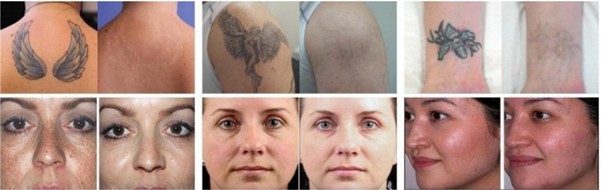 Pico laser before and after tattoo removal and pigmentation treatment